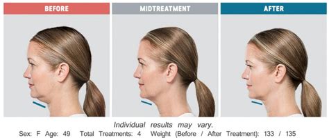 kybella pris|Kybella® in Asia • Check Prices & Reviews .